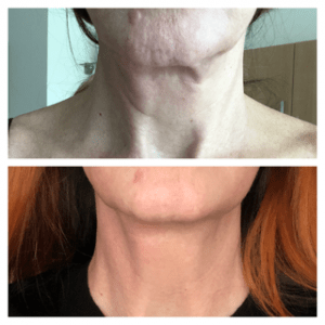 Plasma Pen Neck lift