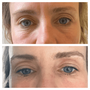 Treatment for crows feet using Plasma Pen