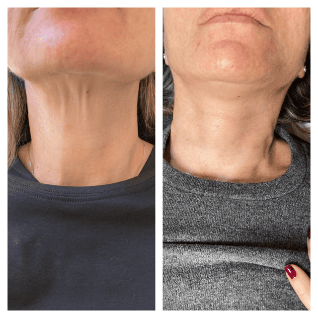 plasma pen neck treatment
