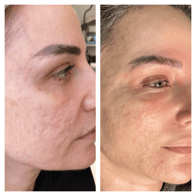 Acne scar treatment using Plasma Pen